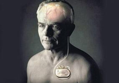 起搏器真的能治好帕金森病嗎？