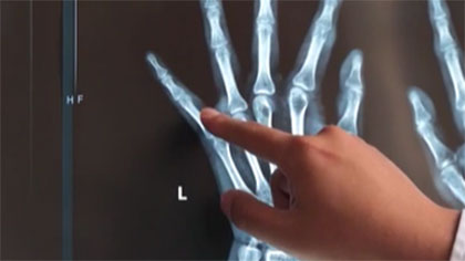 飲食不節(jié)制 19歲小伙兒全身遍布&ldquo;痛風石&rdquo;